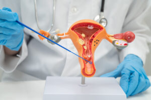 Ovary Problems - Best IVF Doctor in India